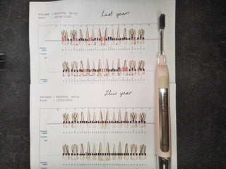 My dental chaart before and after using the Soladey Rhythm 2 toothbrush